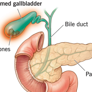 Gall stones