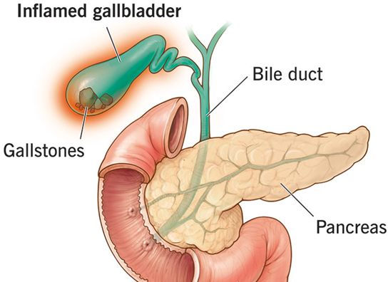Gall stones